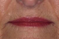 laser resurfacing before