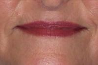 laser resurfacing after