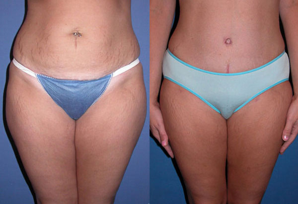 How tight should compression garment be after liposuction?