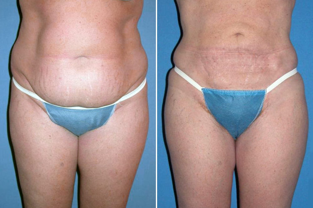 Before and after liposuction with Dr. Branman in Little Rock