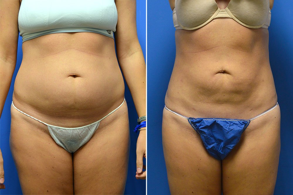 Liposuction before and after photo front view