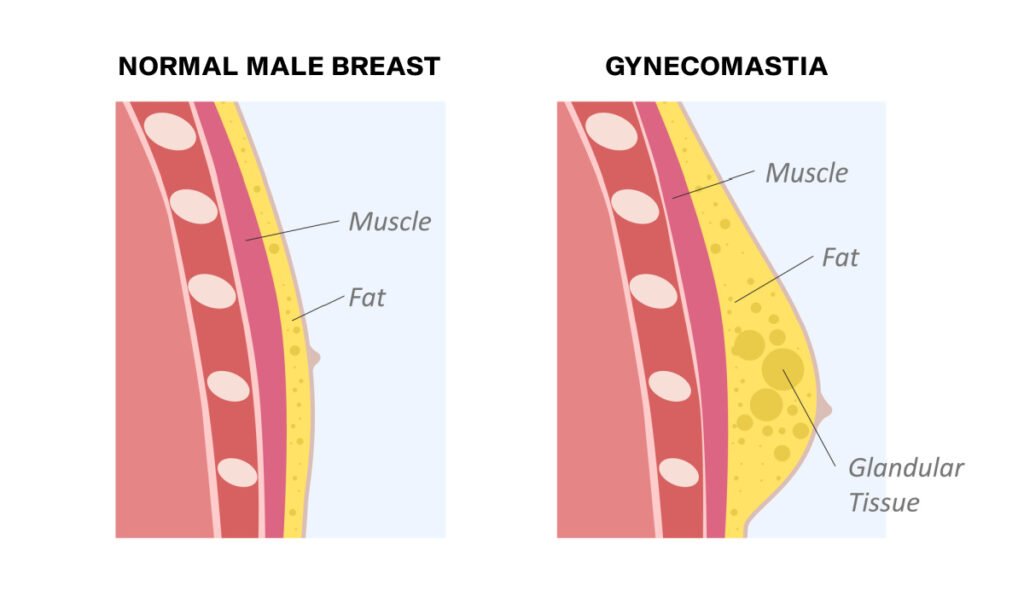 Illustration of normal male breast compared to male breast with gynecomastia