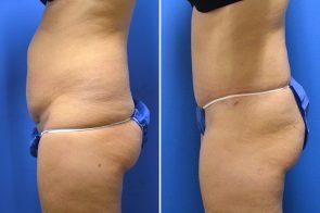 abdominoplasty-161c-branman