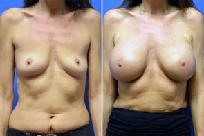 Breast Augmentation Case # 257