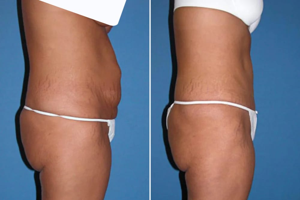 Before and after Little Rock tummy tuck with Dr. Branman