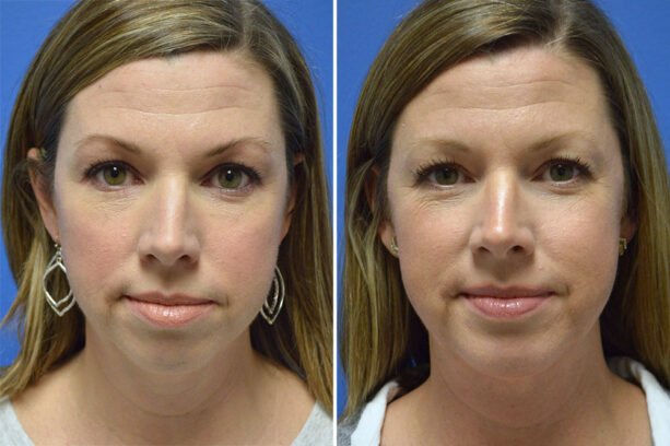 Before and after chin implant surgery with Little Rock cosmetic surgeon Dr. Rhys Branman