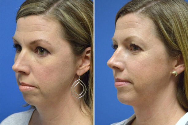 Before and after chin implant surgery with Little Rock cosmetic surgeon Dr. Rhys Branman