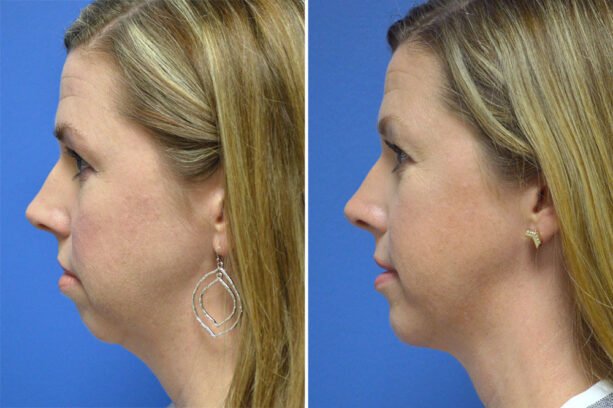 Before and after chin implant surgery with Little Rock cosmetic surgeon Dr. Rhys Branman