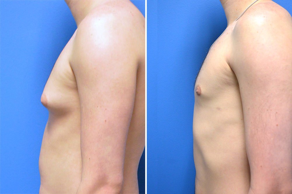 Before and after gynecomastia treatment with Dr. Branman