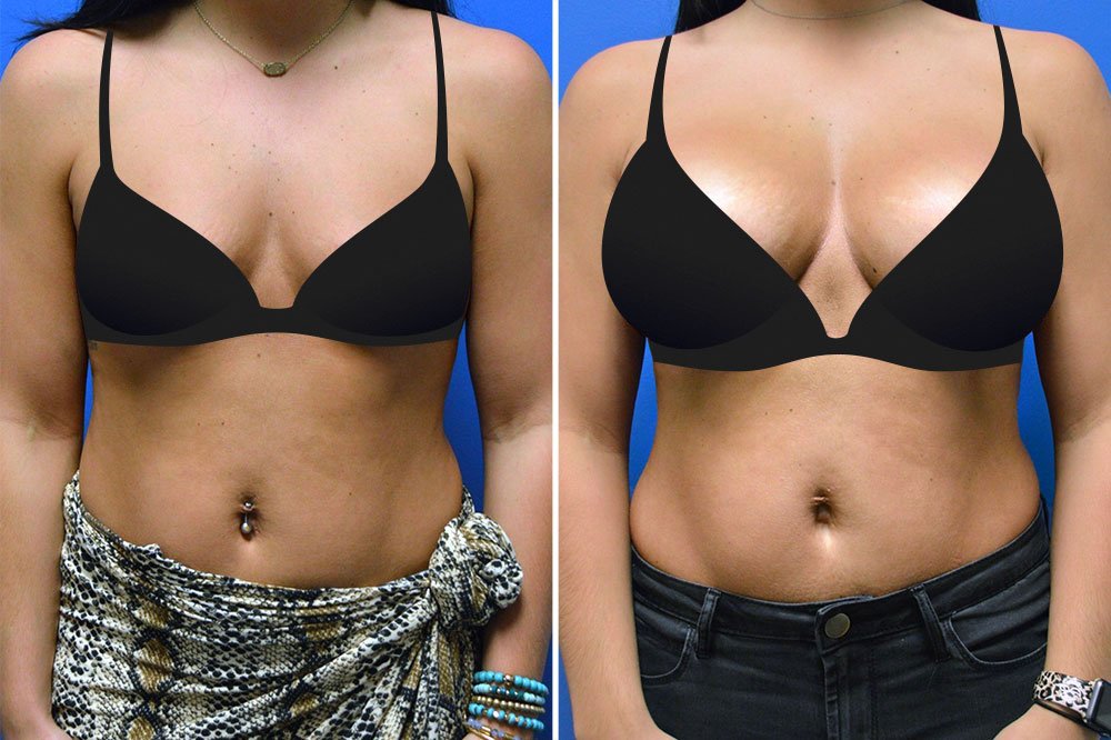 Before and after breast augmentation with Little Rock breast augmentation surgeon Dr. Rhys Branman