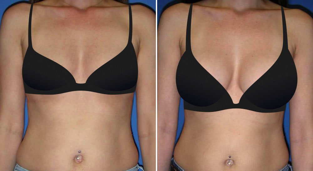 Before and after breast augmentation with Little Rock breast augmentation surgeon Dr. Rhys Branman