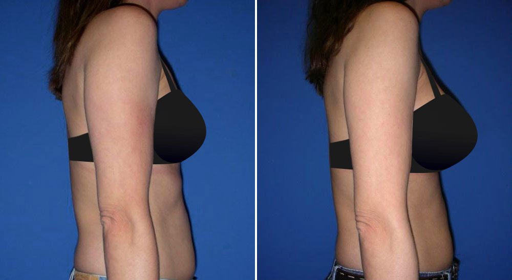 Before and after breast augmentation with Little Rock breast augmentation surgeon Dr. Rhys Branman