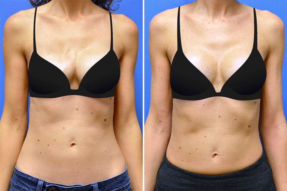 Before and after breast implant revision with Little Rock cosmetic surgeon Dr. Rhys Branman