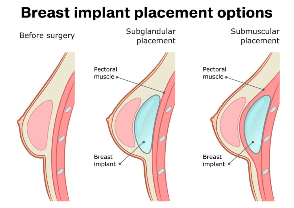 Breast implant placement options: over the muscle vs under the muscle