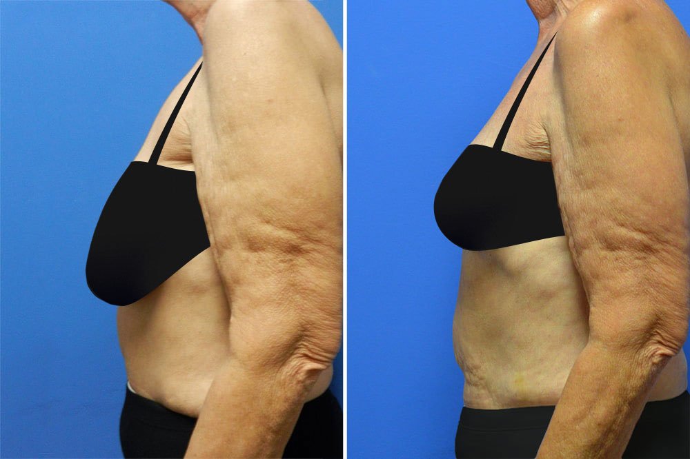 Before and after mastopexy with Little Rock breast lift surgeon Dr. Rhys Branman