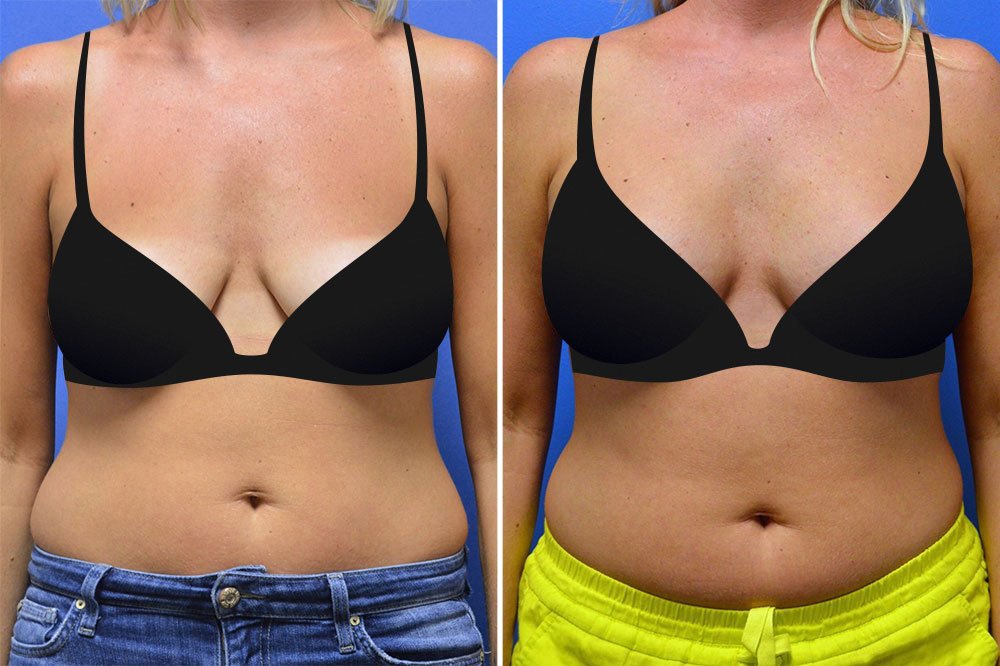 Before and after breast lift with implants with Little Rock breast augmentation surgeon Dr. Rhys Branman