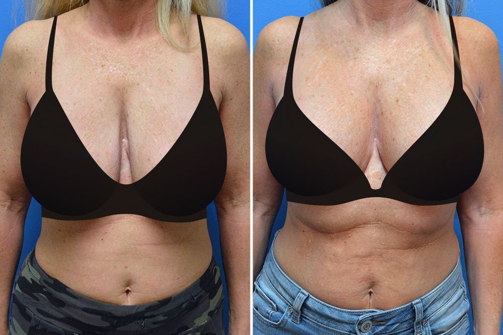 Before and after breast implant removal with a breast lift at the Cosmetic Surgery Center in Little Rock, AR