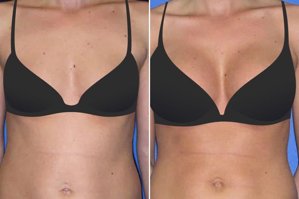 Before and after ballerina breast augmenation with Dr. Rhys Branman in Little Rock