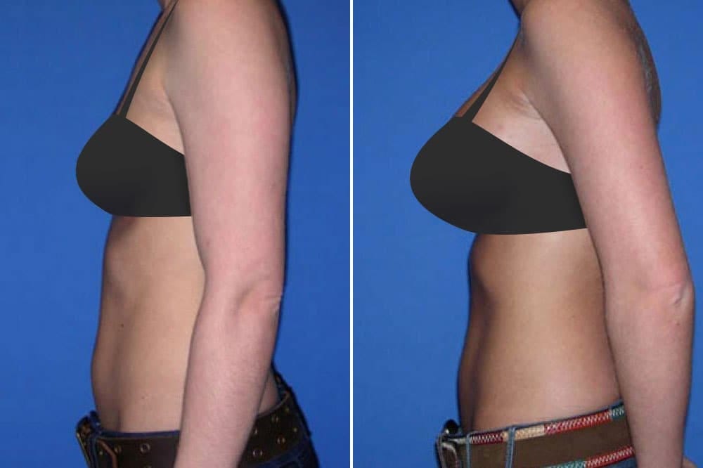 Before and after petite breast augmentation