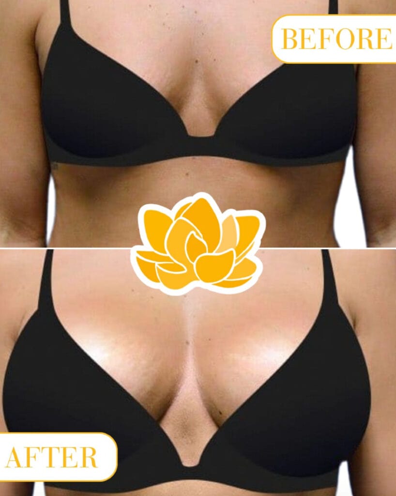 Before and after breast augmentation with Dr. Rhys L. Branman in Little Rock, AR